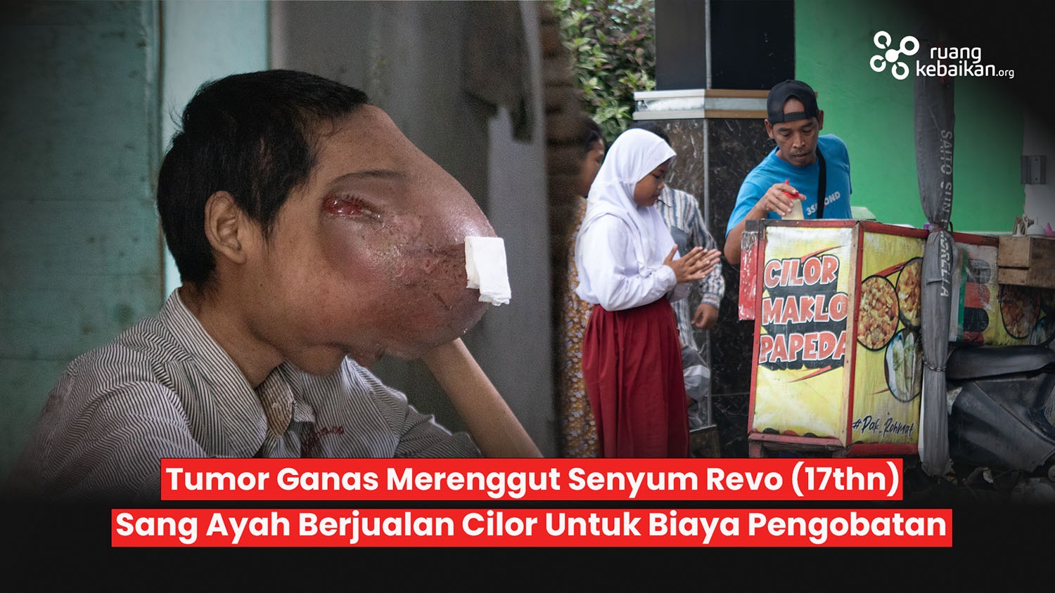 2 Tahun Melawan Tumor Ganas, Wajah Revo sudah Tak Berbentuk