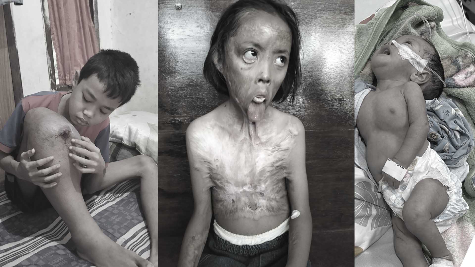 Ribuan Anak Sakit Kronis Terancam Tak Bisa Berobat