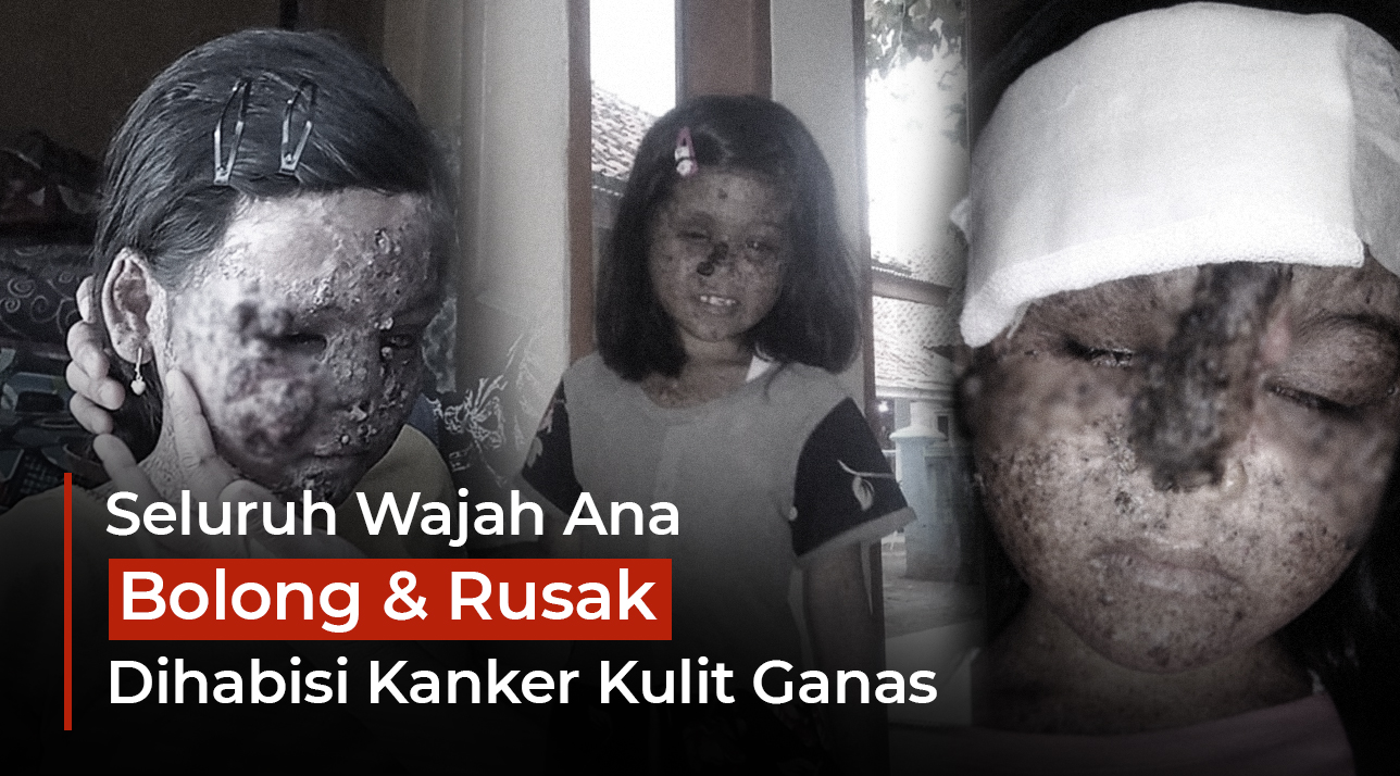 Ribuan Anak Sakit Kronis Terancam Tak Bisa Berobat